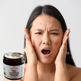 Fra Fra's Mini's | Premium EXTREME Healing Acne Whipped Shea Butter Blend - 4 oz