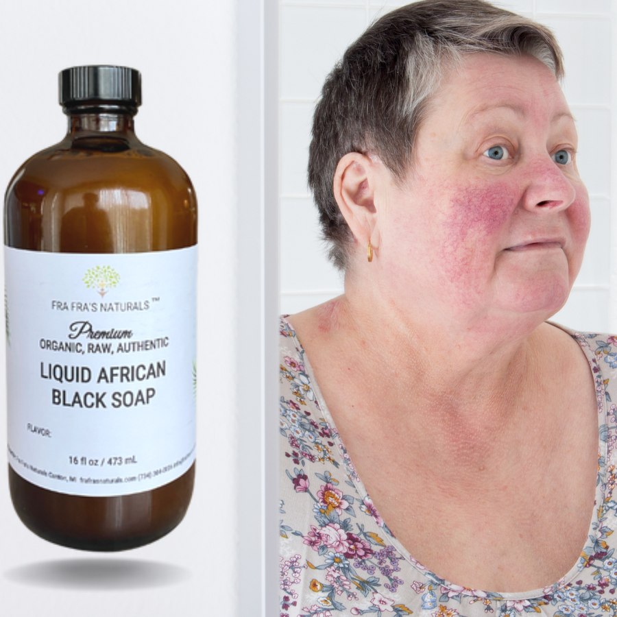 Fra Fra's Naturals | Premium Healing Liquid Black Soap Rosacea Blends
