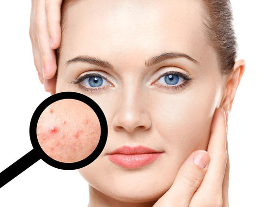 How to help and prevent acne
