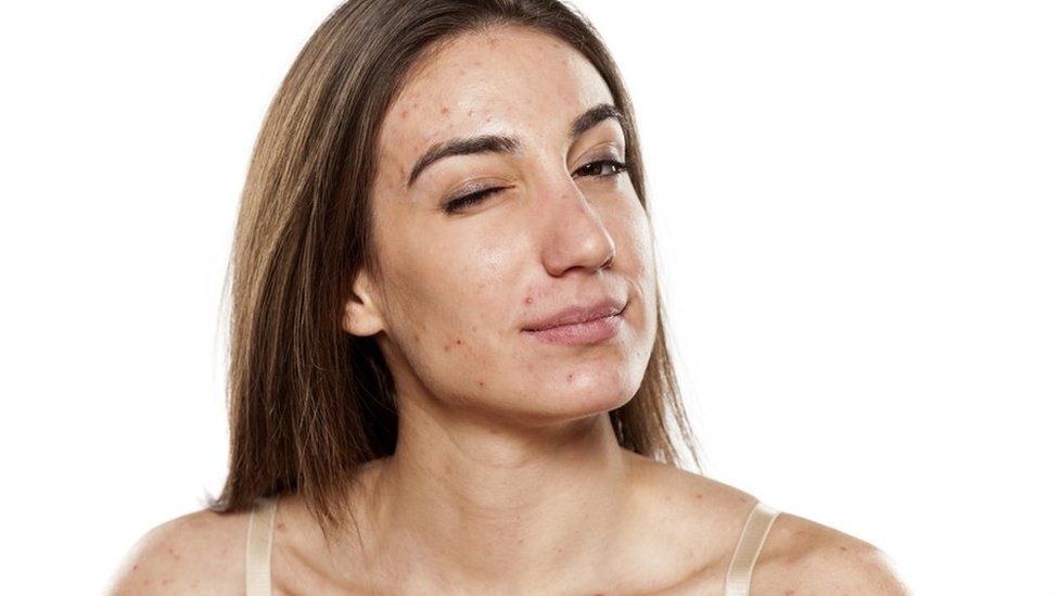 4 REASONS WHY I AM THANKFUL FOR MY ACNE!