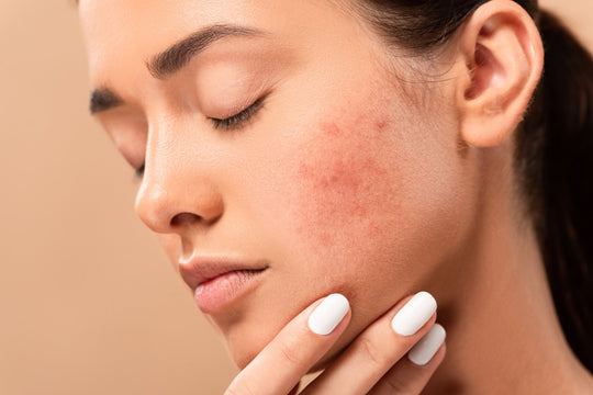 6 Ways to Effectively Remove Acne Scars and Blemishes