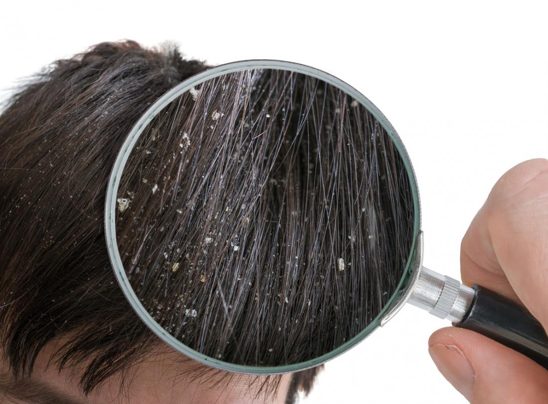 6 Dandruff Myths Debunked
