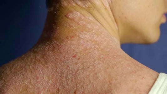 Let's Talk Psoriasis!