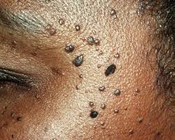 Home Remedies for Skin Tags That You Can Try Easily
