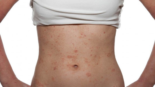 What is eczema and what can you do about it?