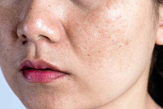 Do Pores Shrink With Age? The Truth About Pore Size