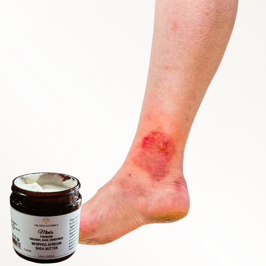 Fra Fra's Mini's | Premium Healing Psoriasis Whipped Shea Butter Blend - 4 oz