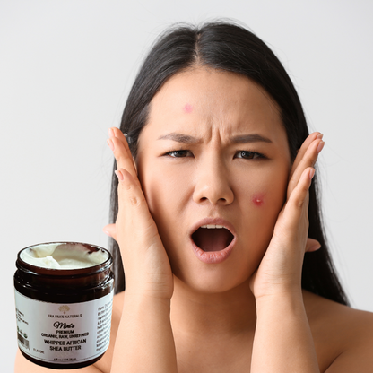 Fra Fra's Mini's | Premium EXTREME Healing Acne Whipped Shea Butter Blend - 4 oz