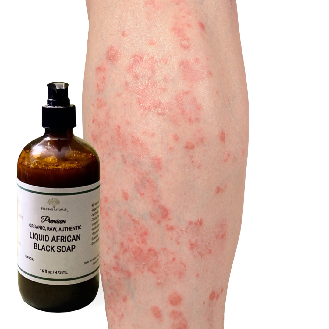 Fra Fra's Naturals | Premium Extreme Healing Psoriasis Liquid African Black Soap Blend - 16 oz
