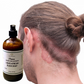 Fra Fra's Naturals I Premium EXTREME Healing Seborrheic Dermatitis Blend