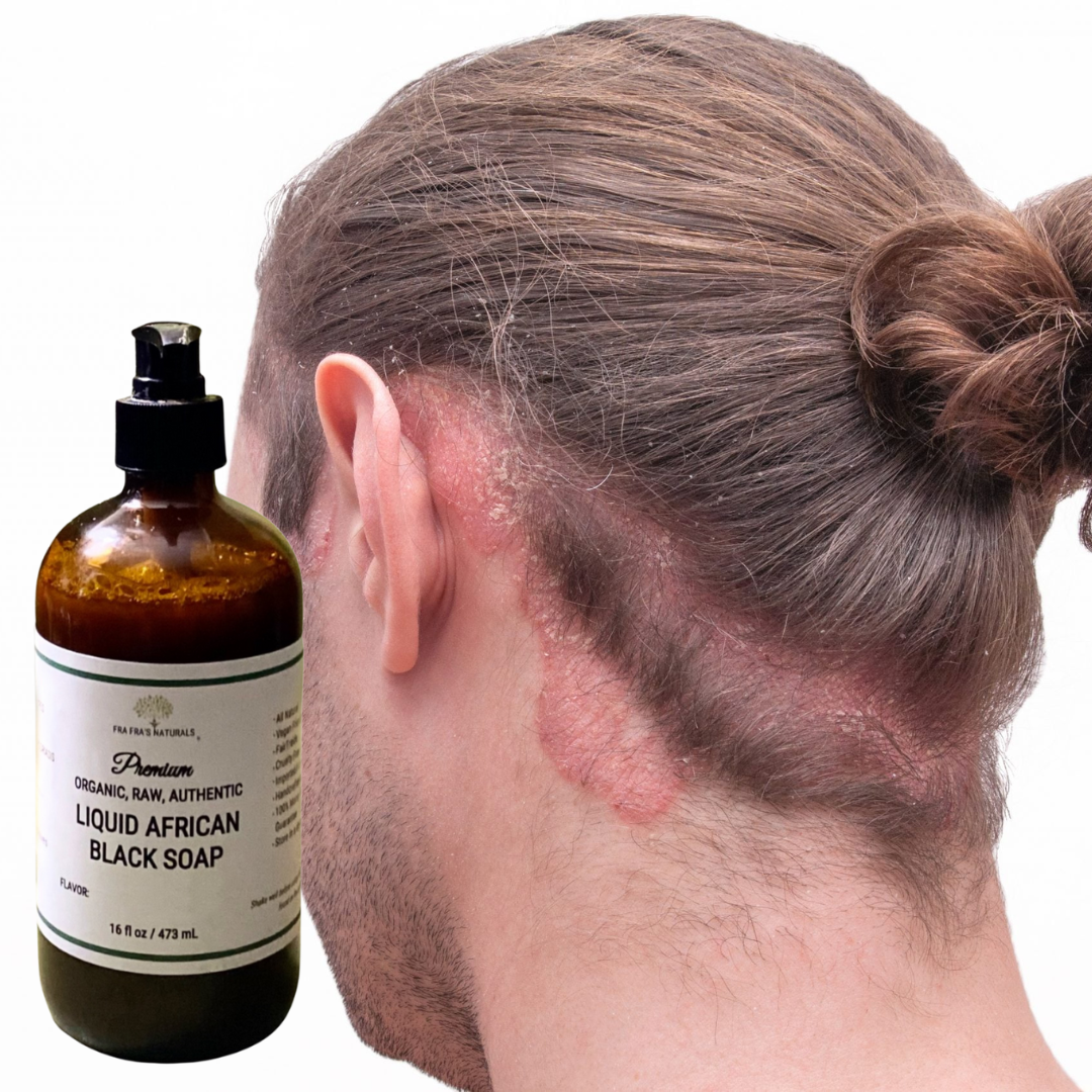 Fra Fra's Naturals I Premium EXTREME Healing Seborrheic Dermatitis Blend