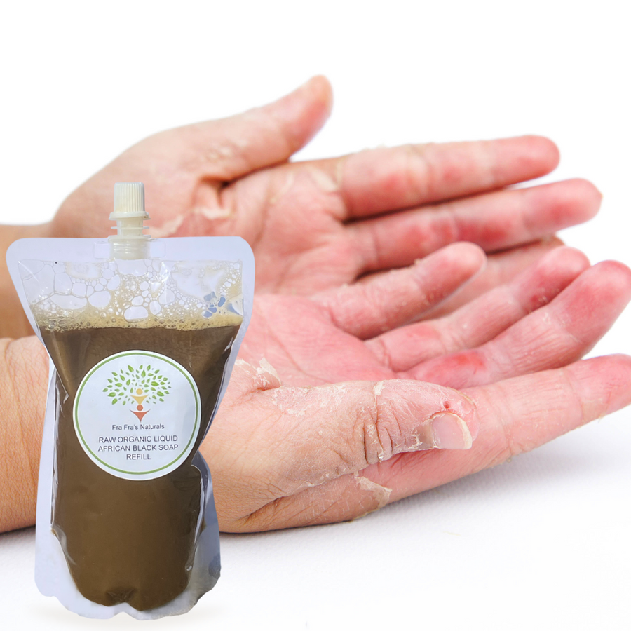 Fra Fra's Naturals | Premium Healing Psoriasis Organic Raw Liquid African Black Soap