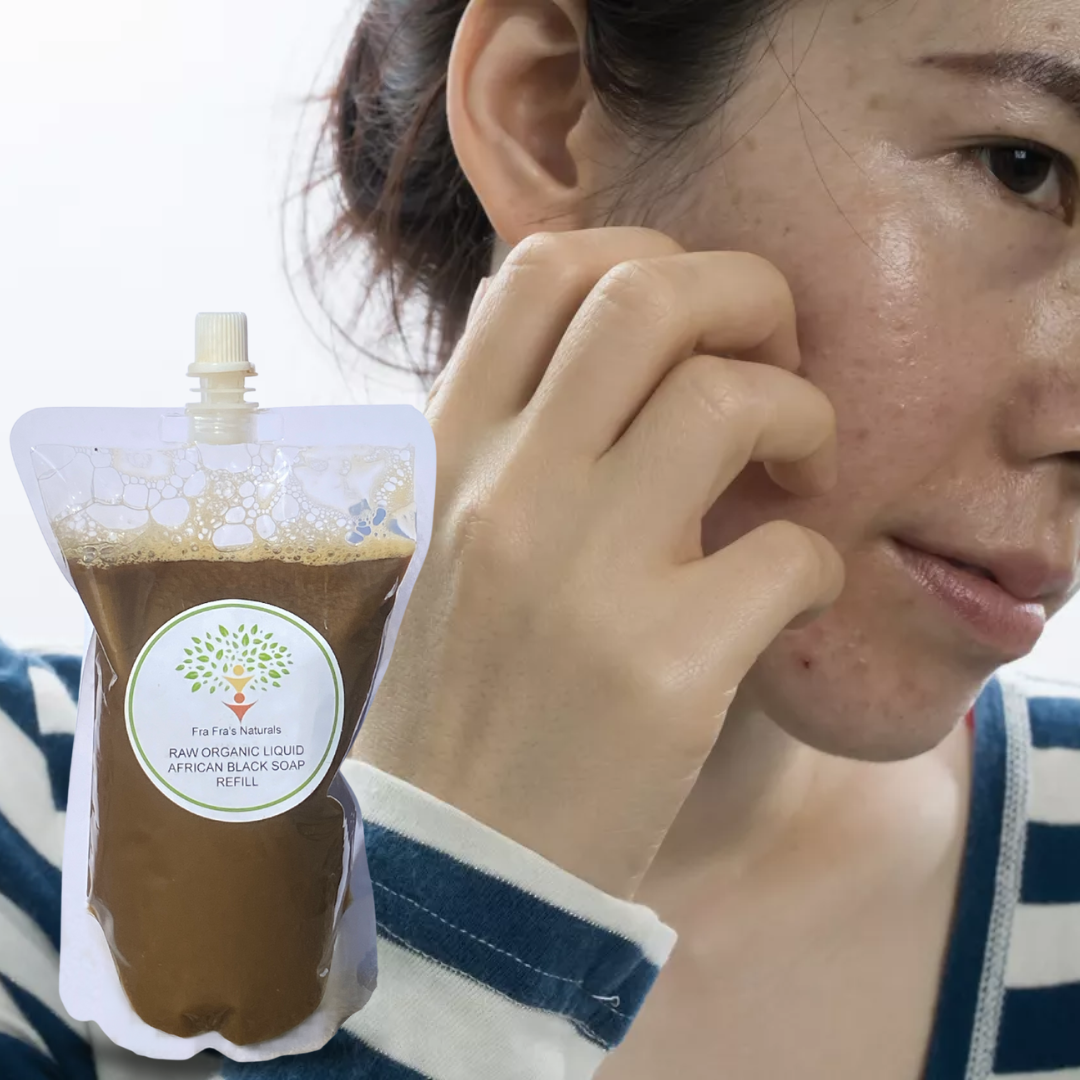 Fra Fra's Naturals I Premium EXTREME Healing Seborrheic Dermatitis Blend