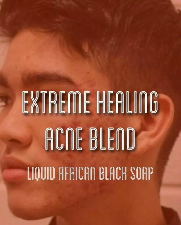 Fra Fra's Naturals | Premium EXTREME Liquid Black Soap Healing Acne Blend