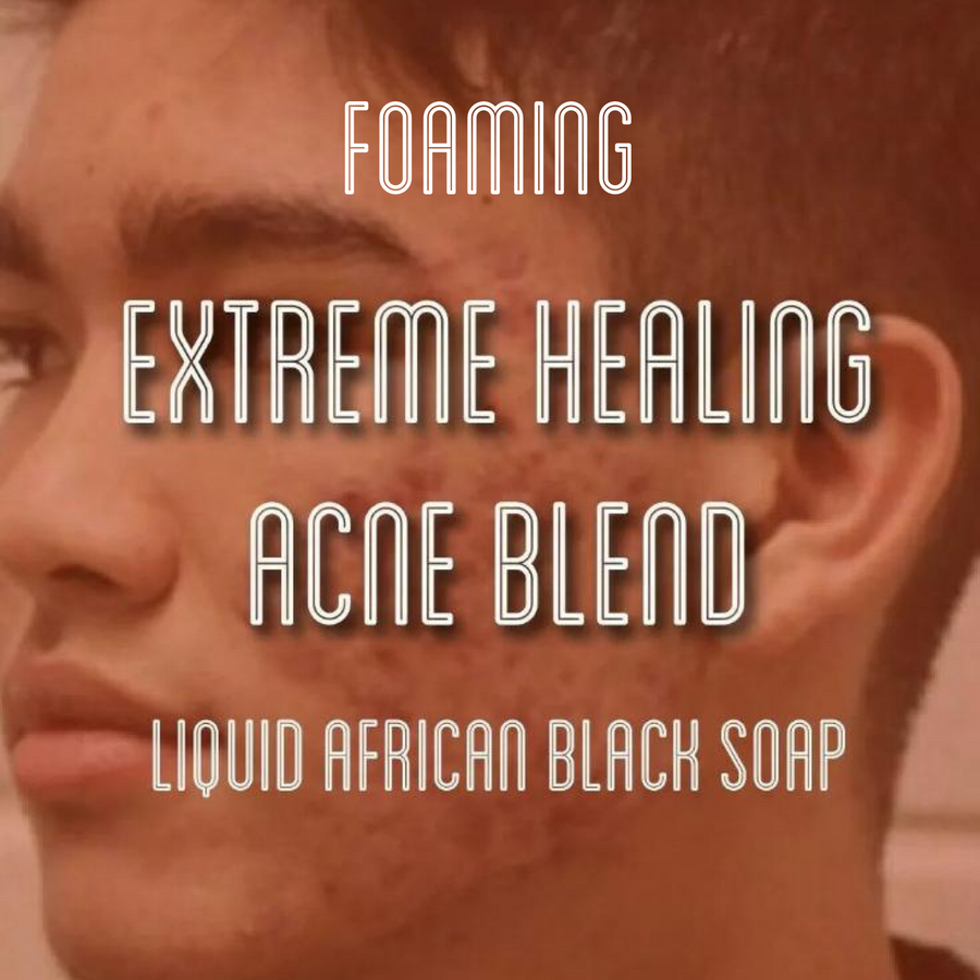Fra Fra's Naturals | Premium EXTREME Healing Acne Foaming African Black Soap Face and Body Wash