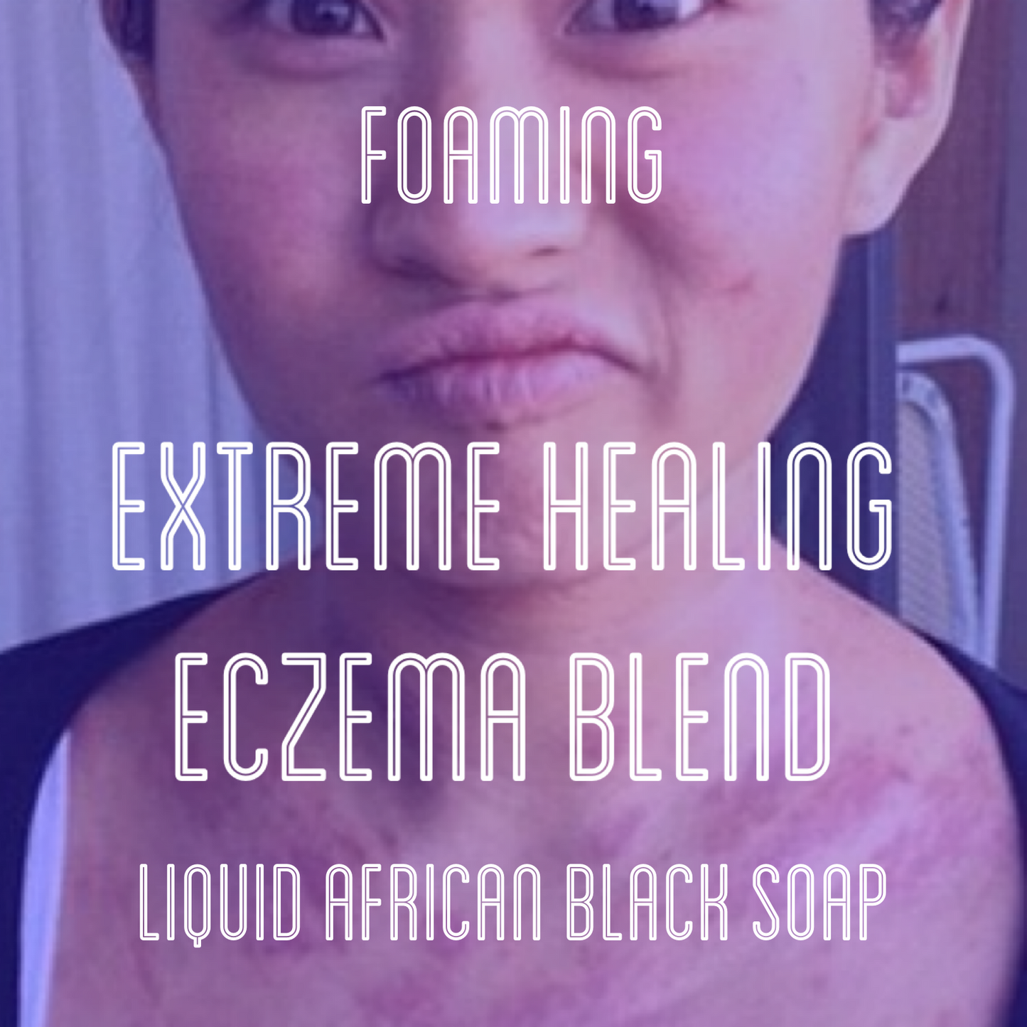 Fra Fra's Naturals | Premium EXTREME Healing Eczema Foaming African Black Soap Face and Body Wash