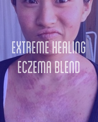 Fra Fra's Naturals | Premium EXTREME Healing Eczema Blends