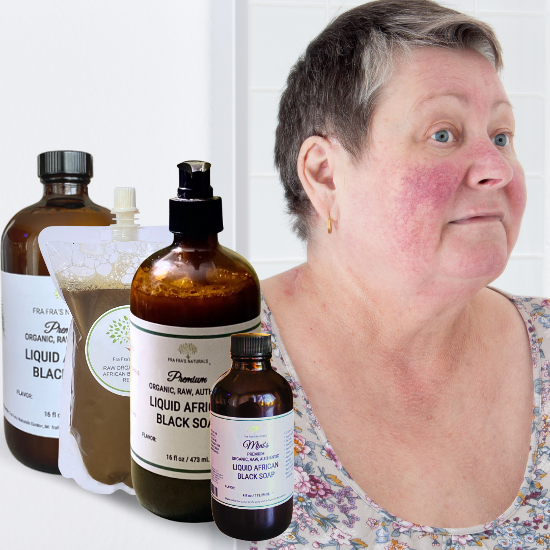 Fra Fra's Naturals | Premium Healing Liquid Black Soap Rosacea Blends
